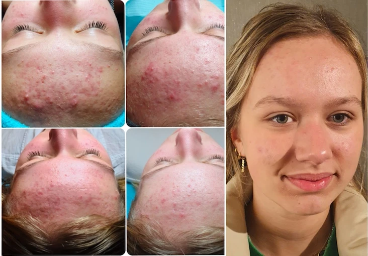 Resultaat biopeeling, acné